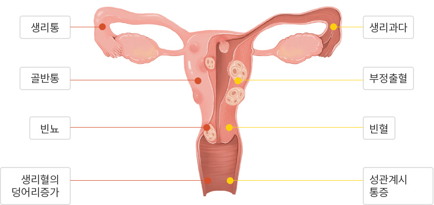 자궁근종·자궁선근증 주요증상